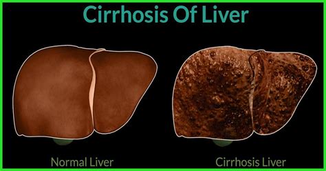 liverosis|Cirrhosis of the Liver: Symptoms, Stages & Treatment